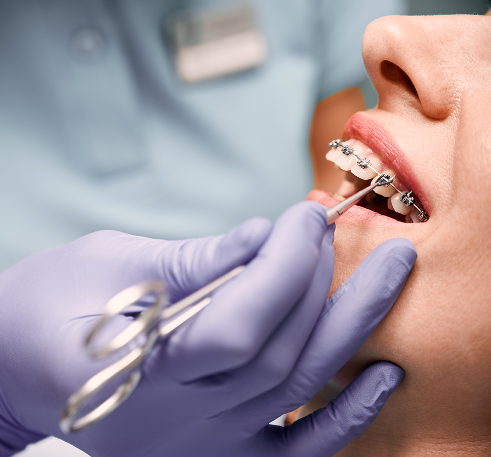 Ajustare aparat dentar la ZahnArt Sibiu