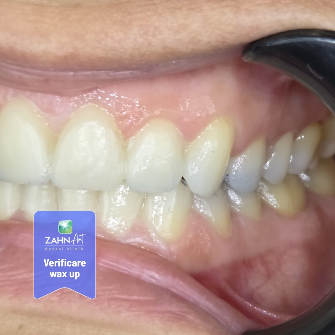 Verificarea wax-up-ului în cavitatea orală, vedere frontală