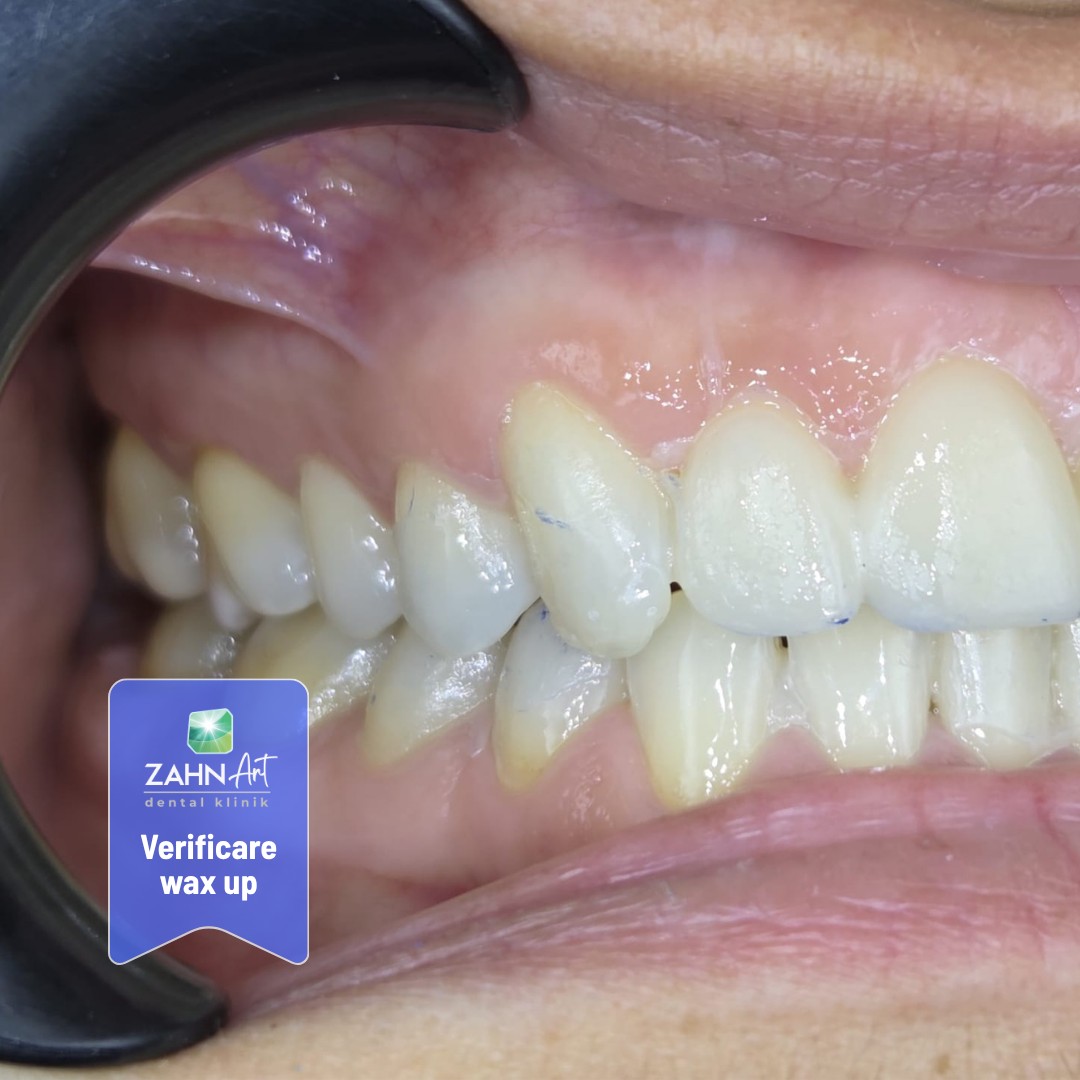 Verificarea wax-up-ului în cavitatea orală, vedere laterală